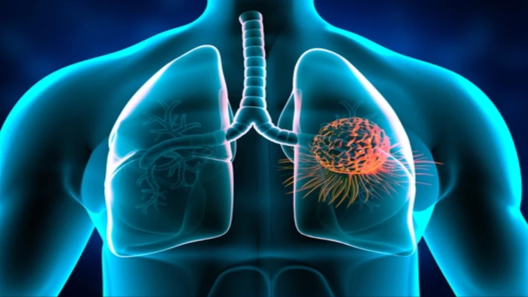 Un tratament inovator extinde viața pacienților cu cancer pulmonar avansat