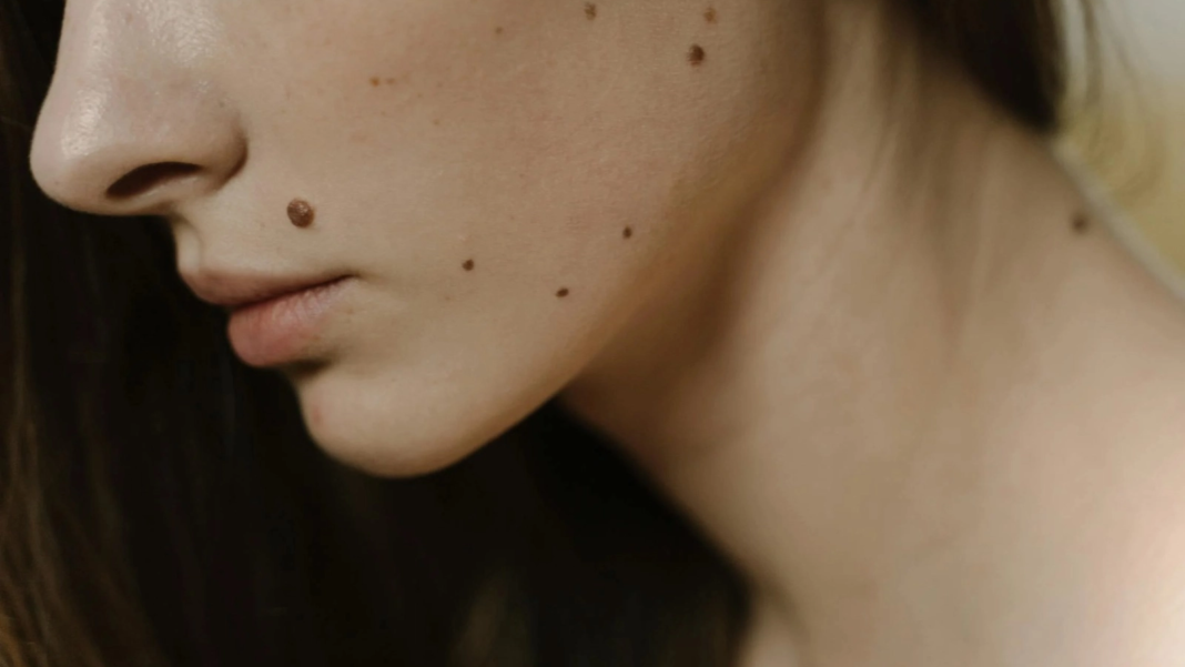 Verificați alunițele după vară, avertizează dermatologul